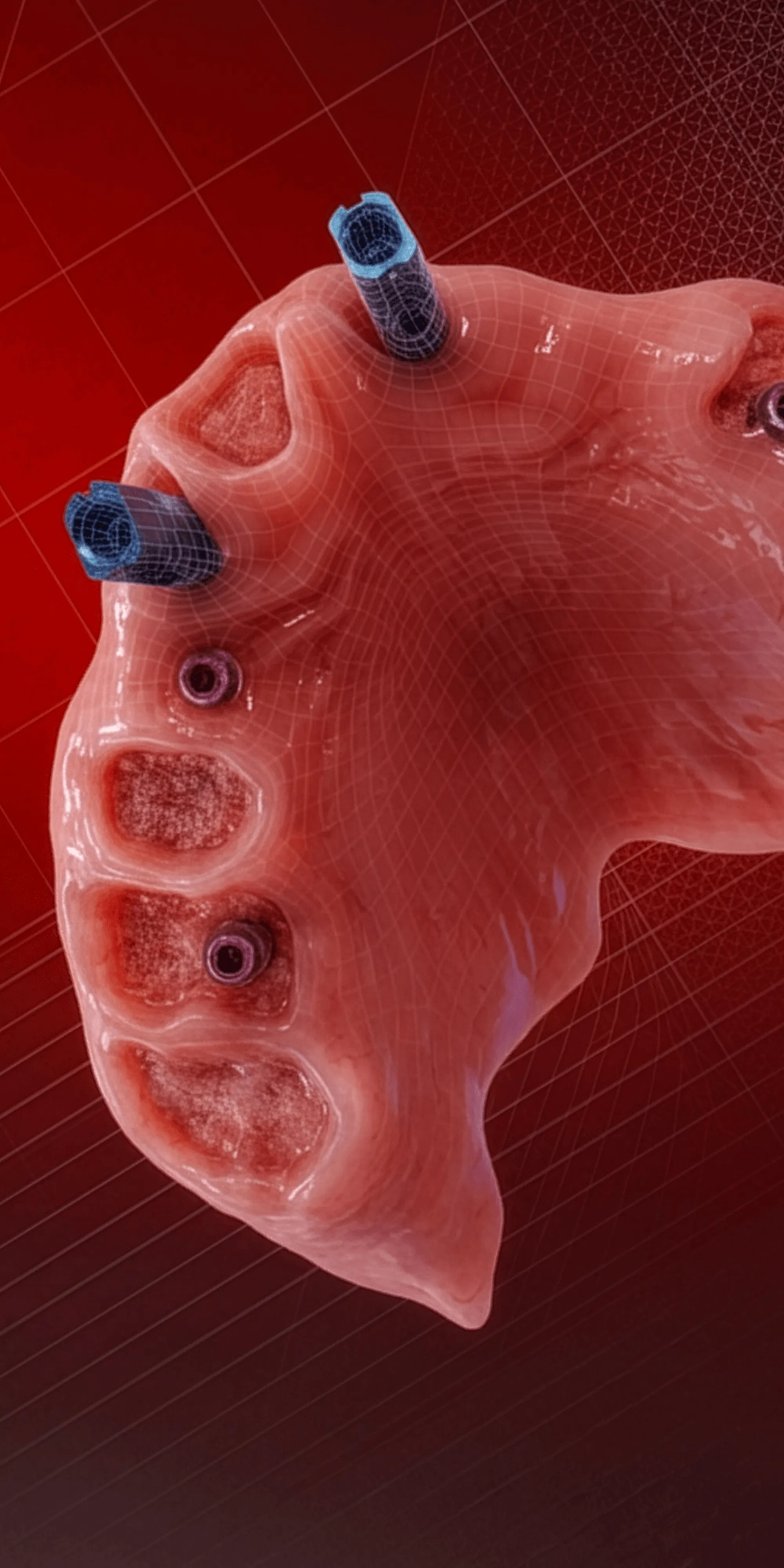 GUIDED STACKABLE FULL ARCH LIVE SURGERY