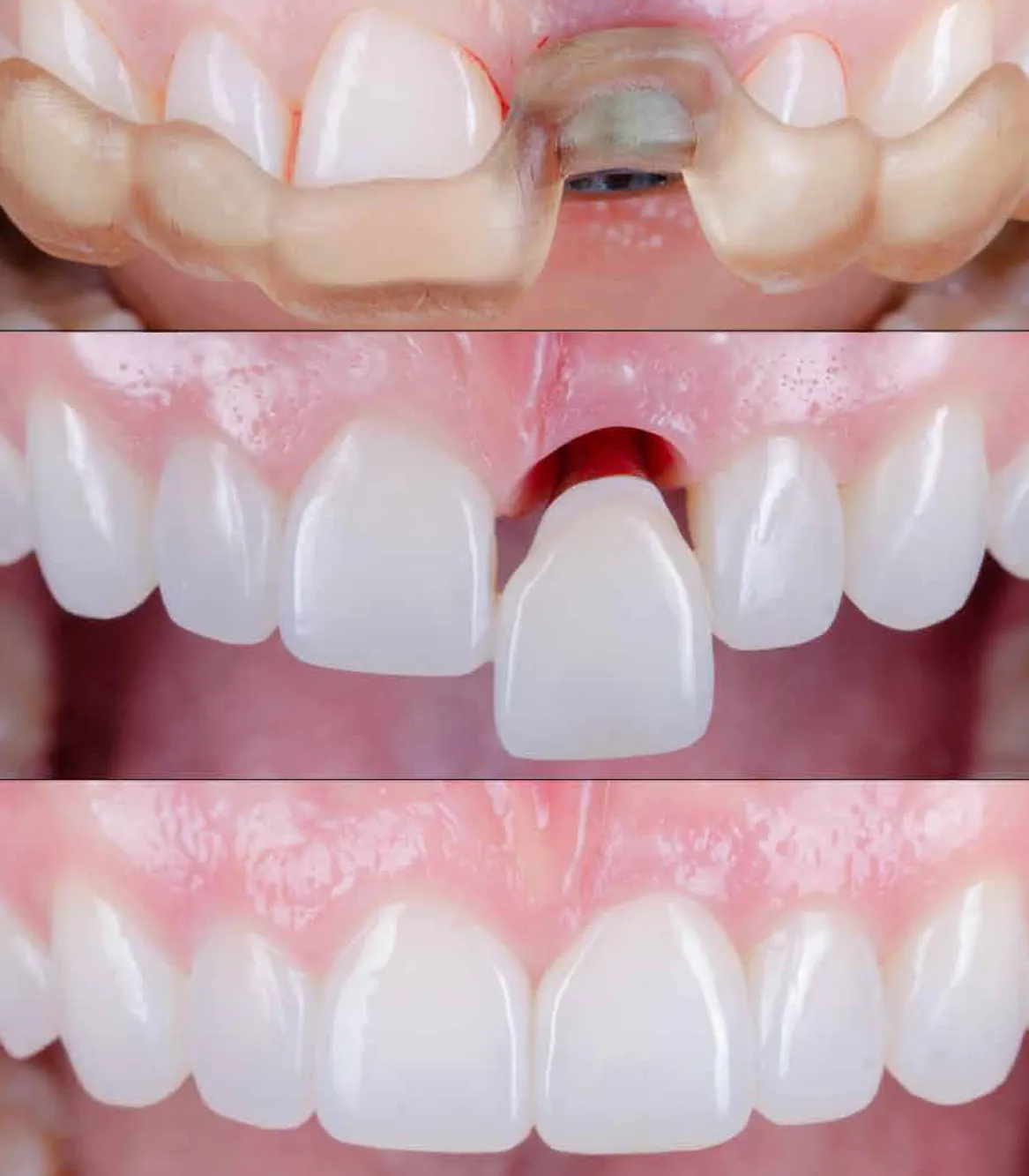 Implant Xperience