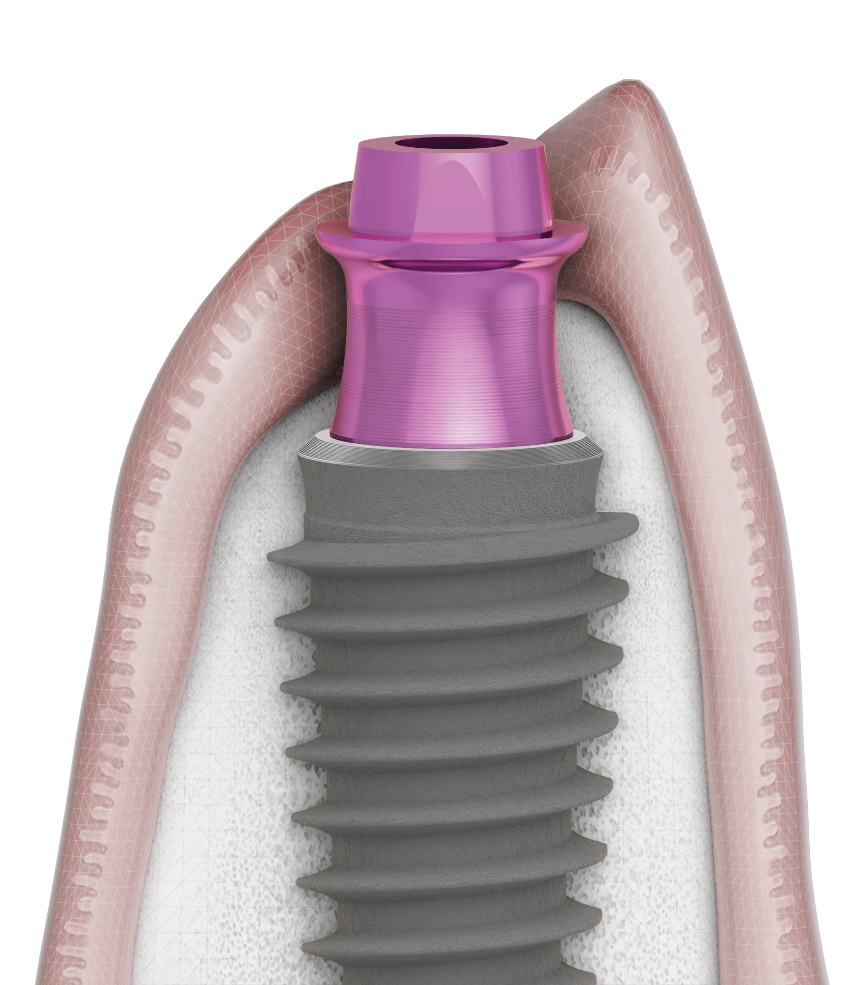 P-3 Implant