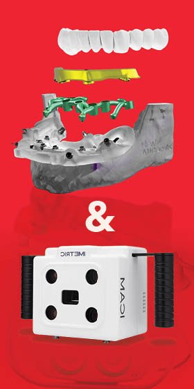 GUIDED STACKABLE SINGLE ARCH LIVE SURGERY