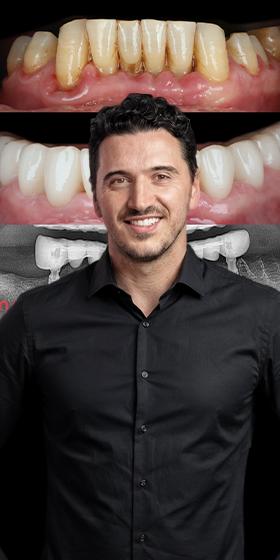 Advanced Digital Full-Arch Workflows