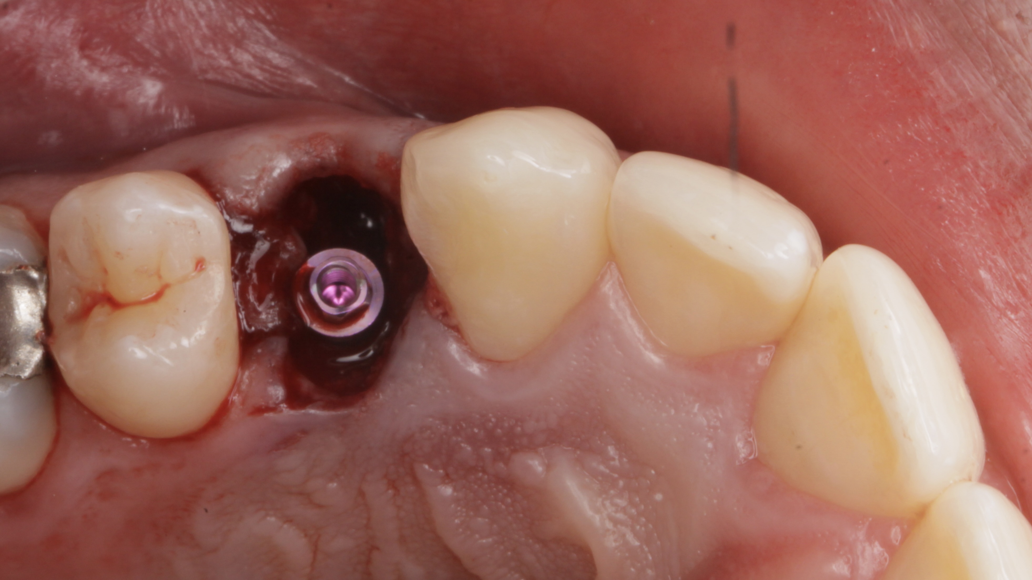 After - Full Arch Surgery with Dr. Khartic Patel
