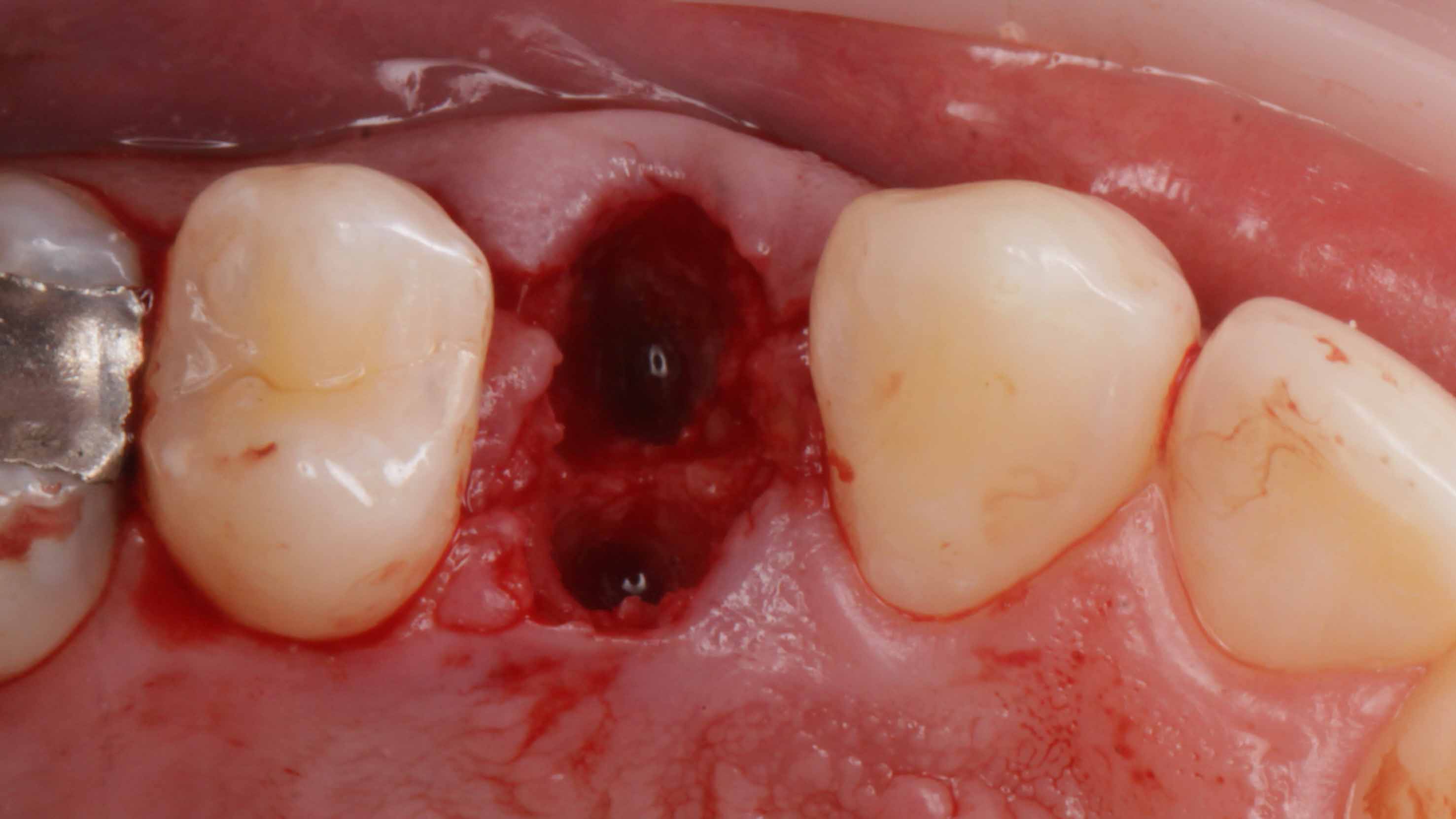 Gallery image for Full Arch Surgery with Dr. Khartic Patel