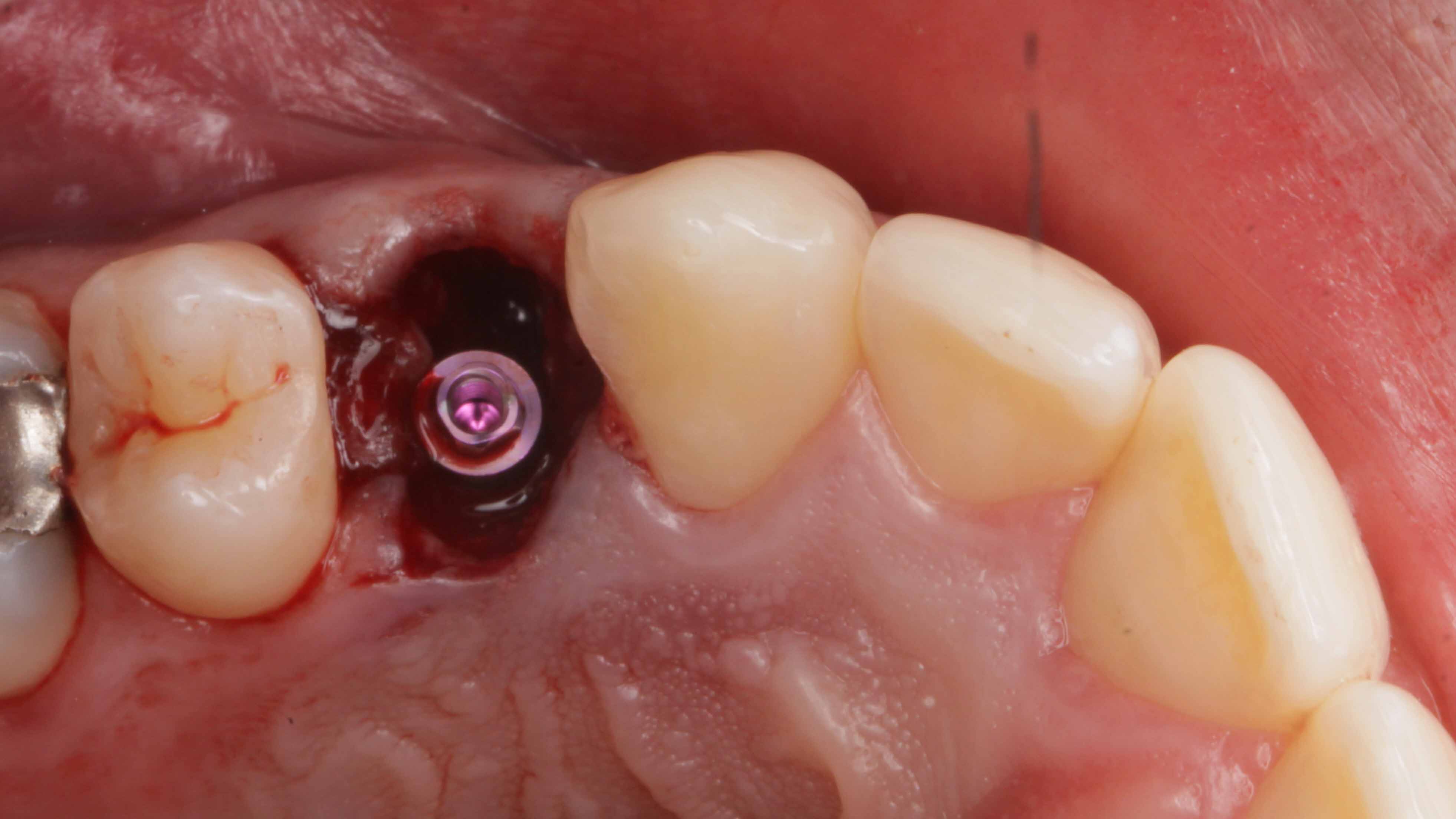 Gallery image for Full Arch Surgery with Dr. Khartic Patel