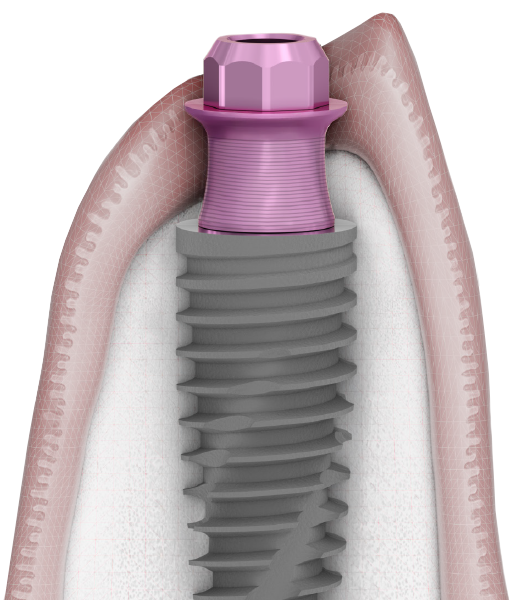 P-3 Implant